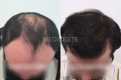before-after-13