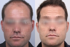 before-after-14