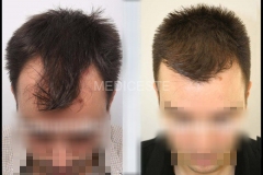 before-after-20