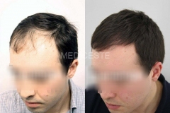 before-after-21