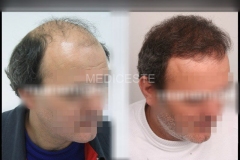 before-after-25