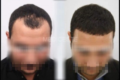 before-after-3-1