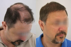 before-after-5-1