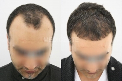 before-after-8